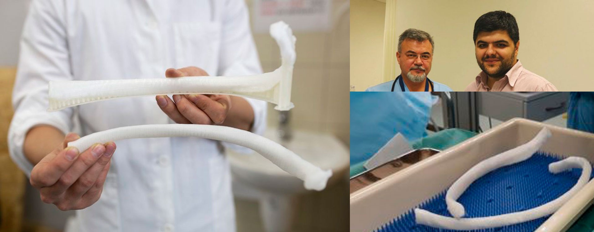Болгарские врачи имплантировали первое ребро, напечатанное на 3D-принтере