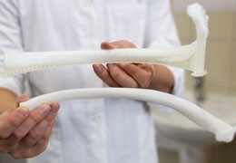 Болгарские врачи имплантировали первое ребро, напечатанное на 3D-принтере